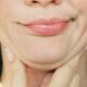 chin fat removal cost